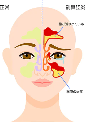 副鼻腔炎（蓄膿症）とは