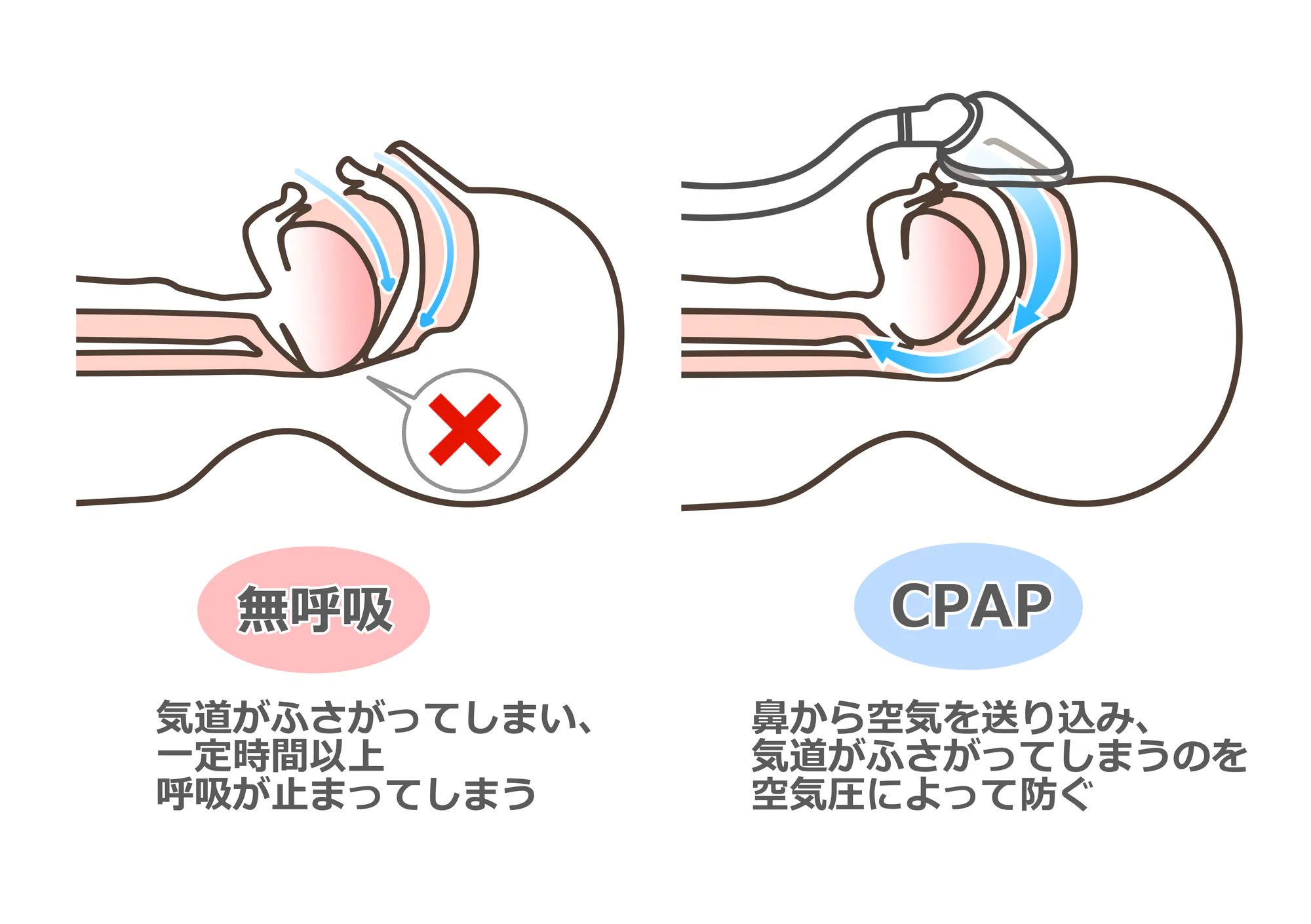 1.持続陽圧呼吸療法（CPAP療法）
